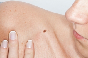 judithcrowellmd-moles-dermatologia-miamiflorida